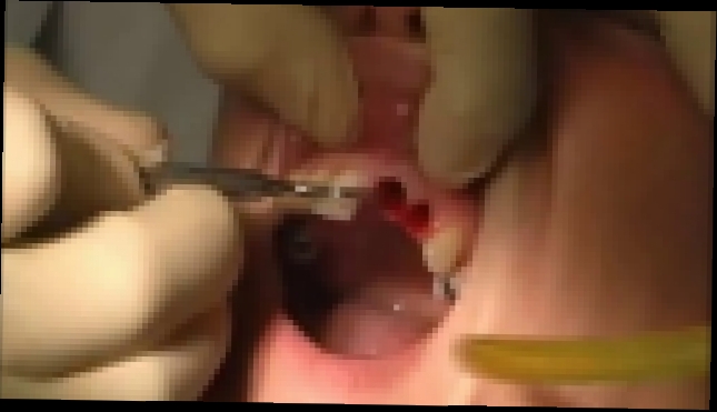 Боли после удаления зуба - Альвеолит 
