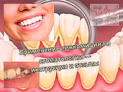 Применение линкомицина в стоматологии — инструкция и отзывы 